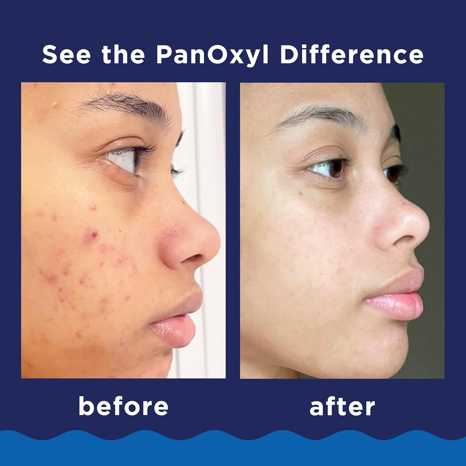 A maximum strength acne treatment products